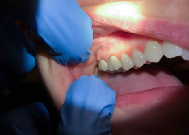Best Emergency Dental Care for Abscessed Tooth in Duryea, PA